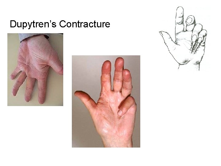 Dupytren’s Contracture 