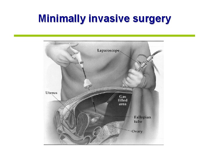 Minimally invasive surgery 