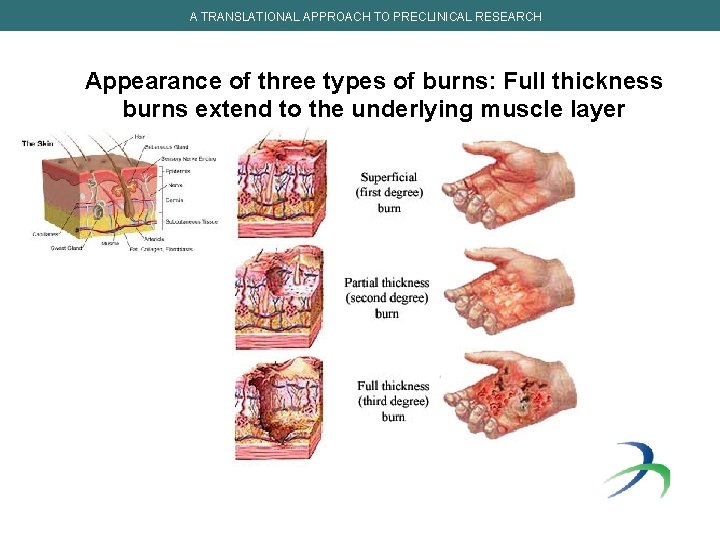 A TRANSLATIONAL APPROACH TO PRECLINICAL RESEARCH Appearance of three types of burns: Full thickness