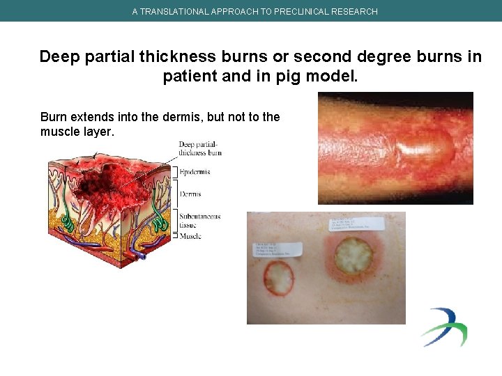 A TRANSLATIONAL APPROACH TO PRECLINICAL RESEARCH Deep partial thickness burns or second degree burns