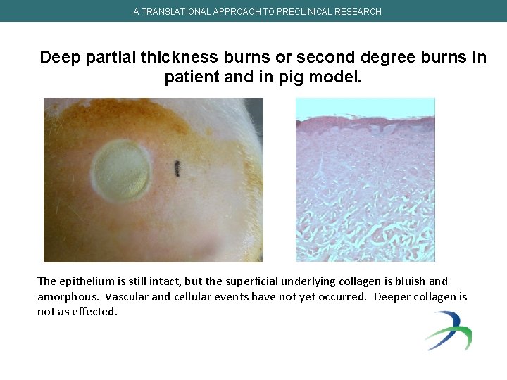 A TRANSLATIONAL APPROACH TO PRECLINICAL RESEARCH Deep partial thickness burns or second degree burns