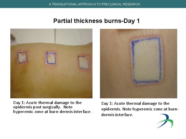 A TRANSLATIONAL APPROACH TO PRECLINICAL RESEARCH Partial thickness burns-Day 1: Acute thermal damage to