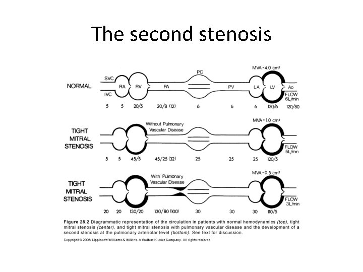The second stenosis 
