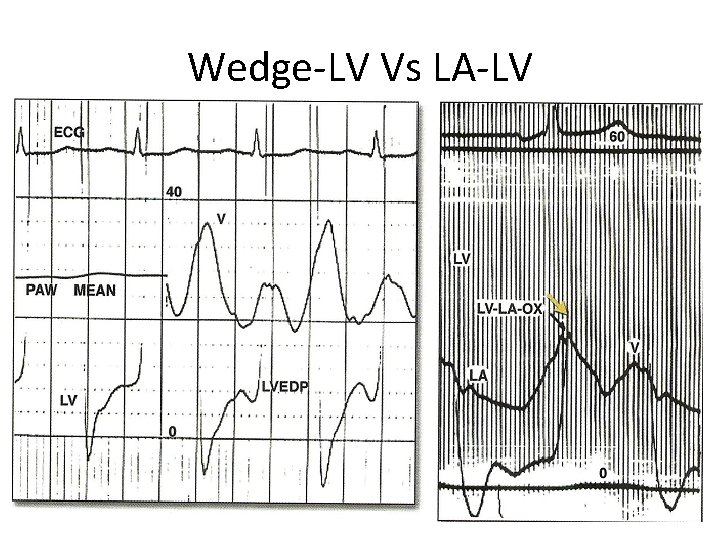 Wedge-LV Vs LA-LV 