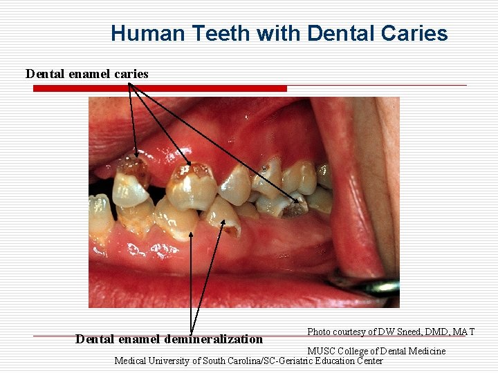 Human Teeth with Dental Caries Dental enamel caries Dental enamel demineralization Photo courtesy of