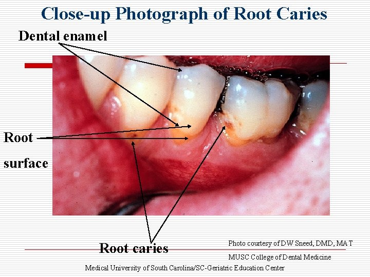 Close-up Photograph of Root Caries Dental enamel Root surface Root caries Photo courtesy of