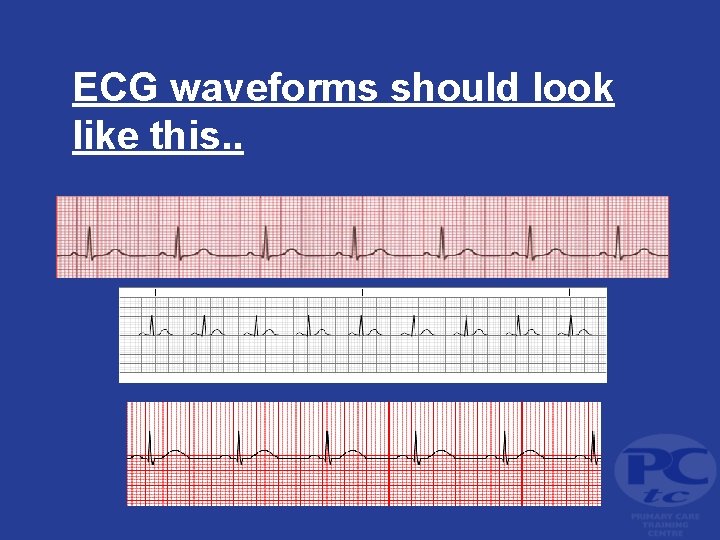 ECG waveforms should look like this. . 