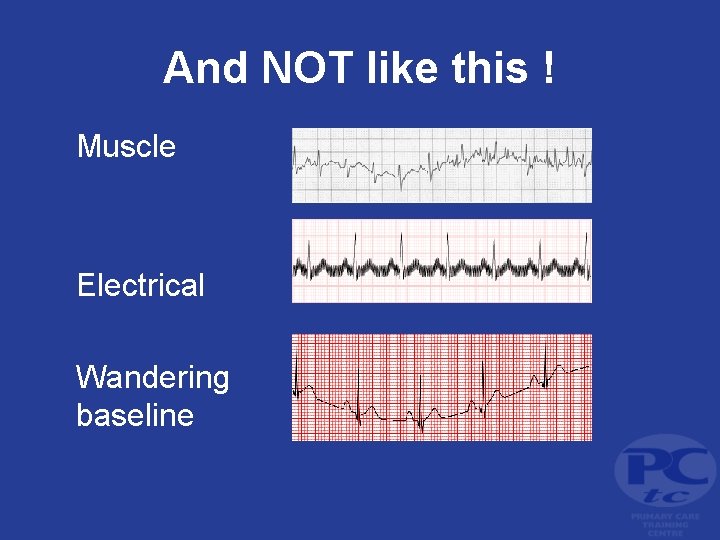 And NOT like this ! Muscle Electrical Wandering baseline 