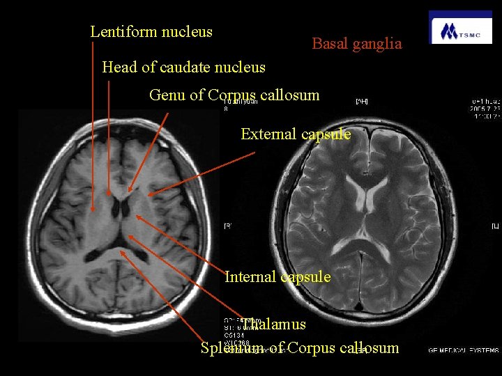 Lentiform nucleus Basal ganglia Head of caudate nucleus Genu of Corpus callosum External capsule