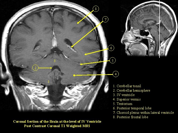 8 7 6 3 5 2 4 1 1. Cerebellar tonsil 2. Cerebellar hemisphere