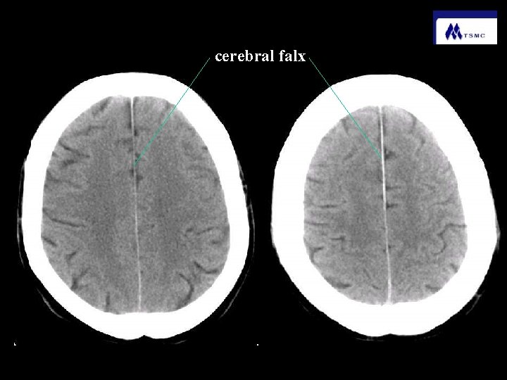 cerebral falx 