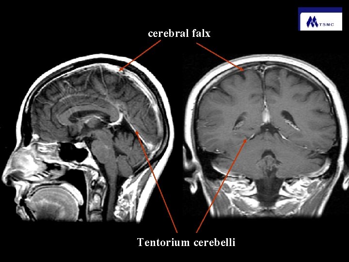 cerebral falx Tentorium cerebelli 