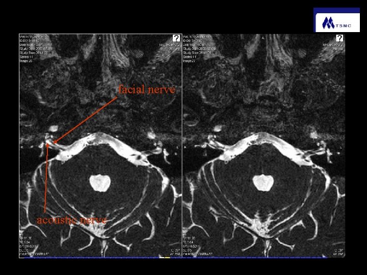 facial nerve acoustic nerve 