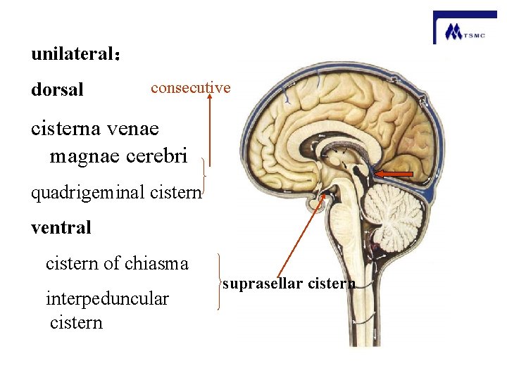 unilateral： dorsal consecutive cisterna venae magnae cerebri quadrigeminal cistern ventral cistern of chiasma interpeduncular