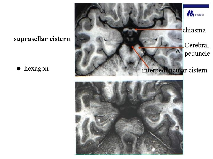 chiasma suprasellar cistern l hexagon Cerebral peduncle interpeduncular cistern 