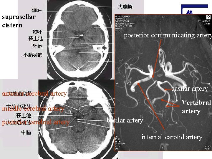 suprasellar cistern posterior communicating artery basilar artery anterior cerebral artery Vertebral artery middle cerebral