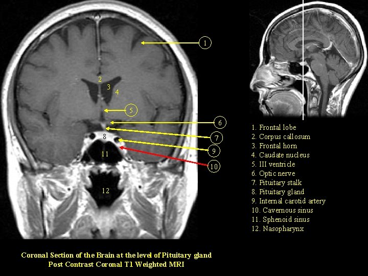 1 2 3 4 5 6 8 7 9 11 10 12 Coronal Section