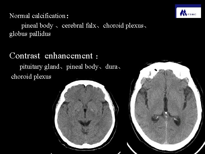 Normal calcification： pineal body 、cerebral falx、choroid plexus、 globus pallidus Contrast enhancement ： pituitary gland、pineal