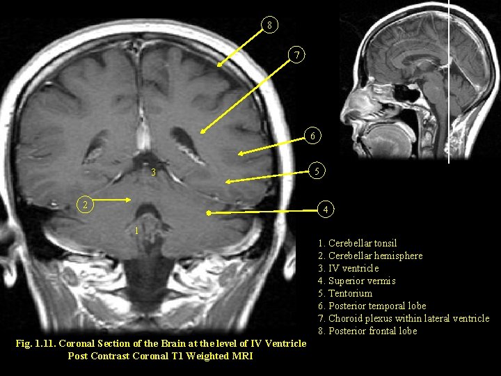 8 7 6 3 2 5 4 1 1. Cerebellar tonsil 2. Cerebellar hemisphere