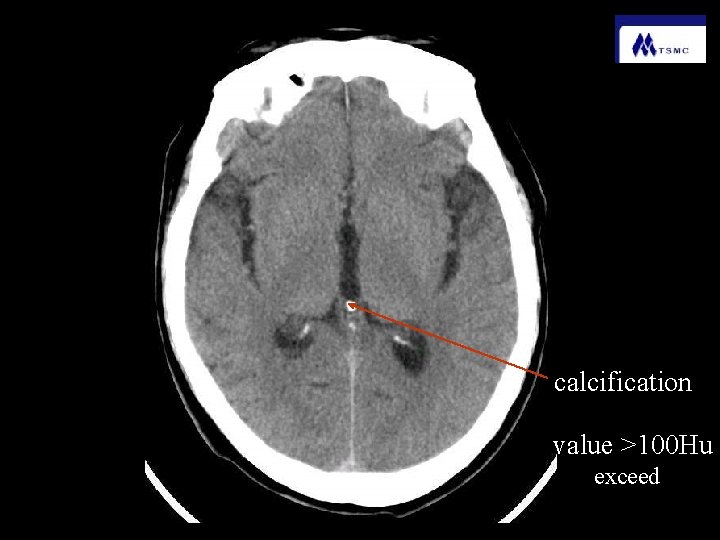 calcification value >100 Hu exceed 