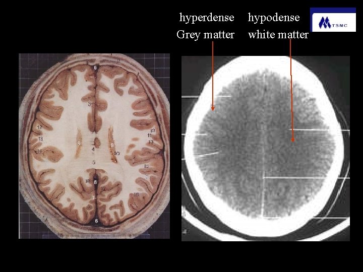 hyperdense Grey matter hypodense white matter 