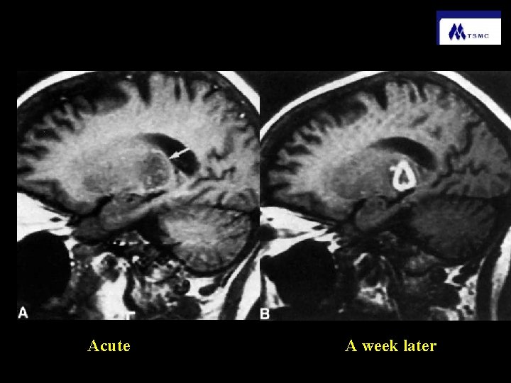 Acute A week later 