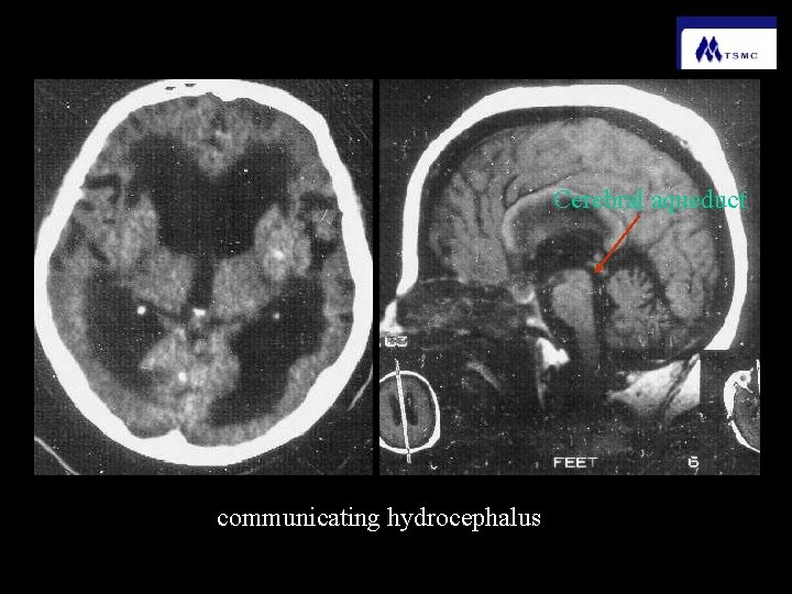 Cerebral aqueduct communicating hydrocephalus 