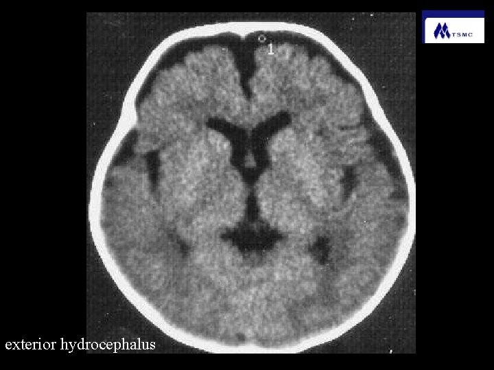 exterior hydrocephalus 