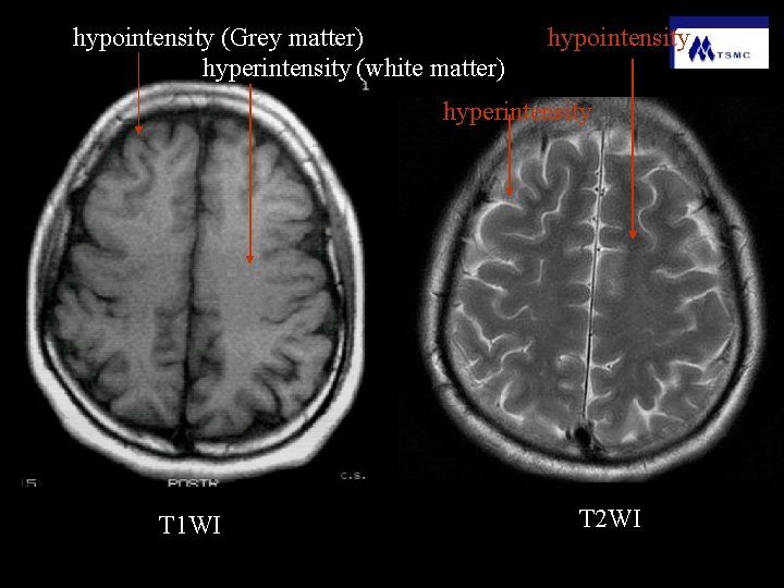 hypointensity (Grey matter) hyperintensity (white matter) hypointensity hyperintensity T 1 WI T 2 WI
