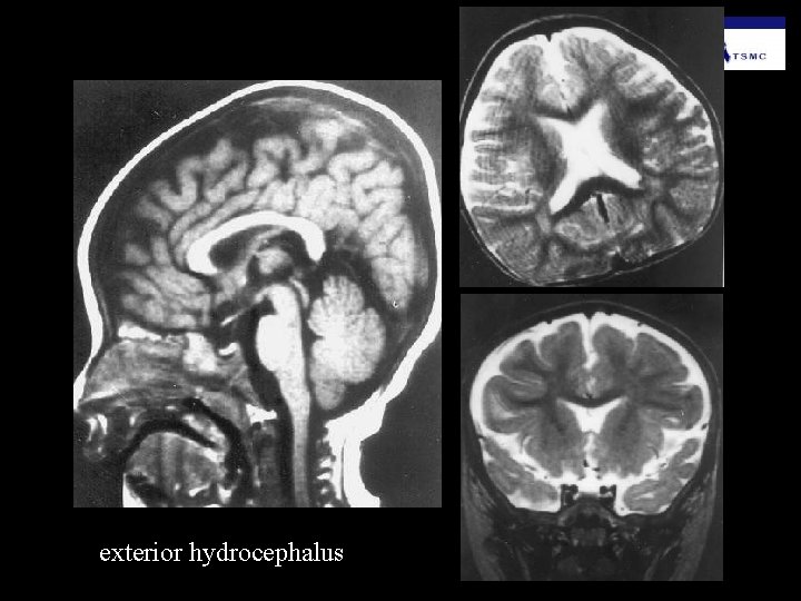 exterior hydrocephalus 