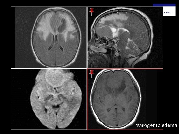 vasogenic edema 