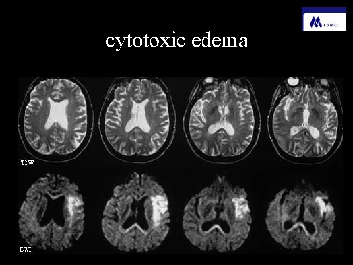 cytotoxic edema 