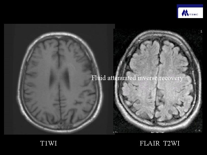 Fluid attenuated inverse recovery T 1 WI FLAIR T 2 WI 