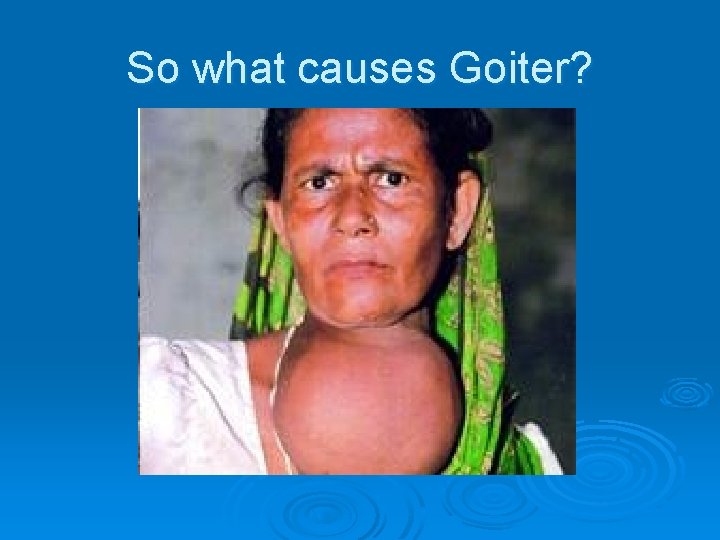 So what causes Goiter? 