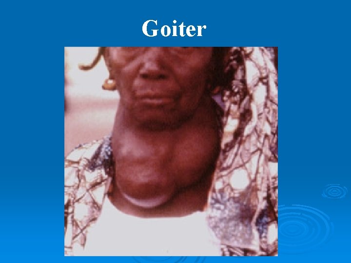 Goiter 