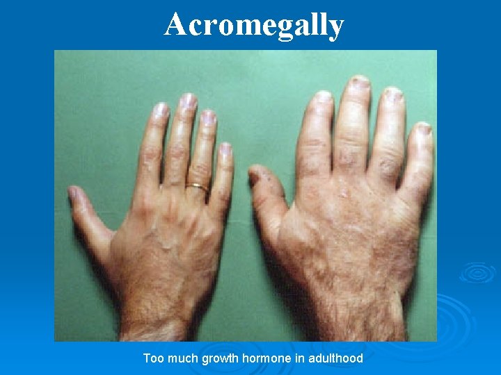 Acromegally Too much growth hormone in adulthood 