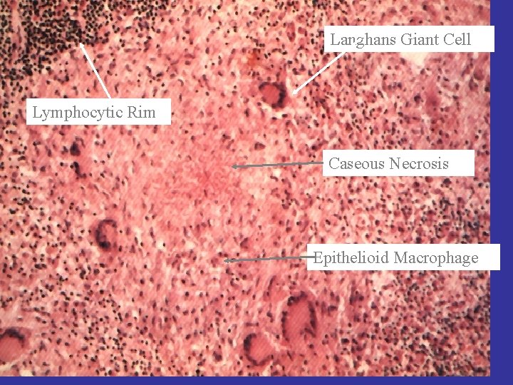 Langhans Giant Cell Granuloma Lymphocytic Rim Caseous Necrosis Epithelioid Macrophage 