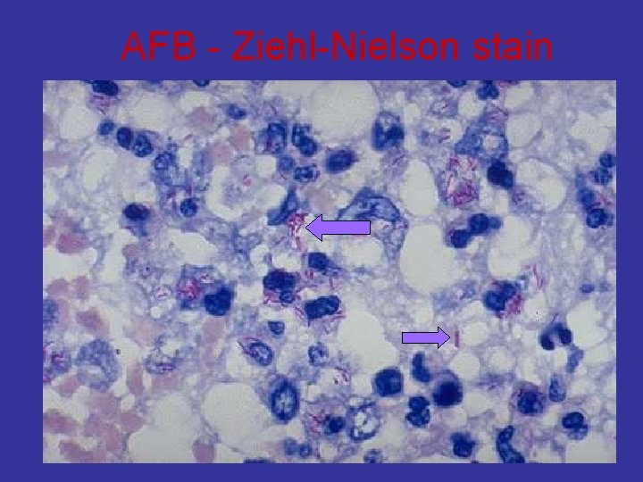 AFB - Ziehl-Nielson stain 