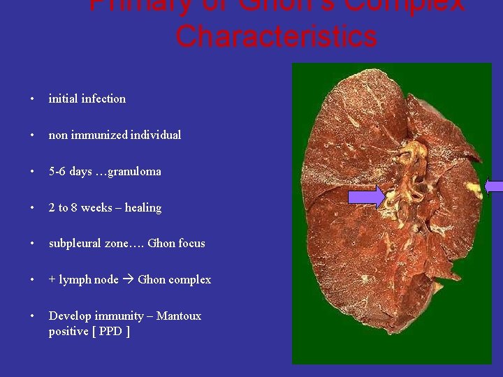 Primary or Ghon’s Complex Characteristics • initial infection • non immunized individual • 5