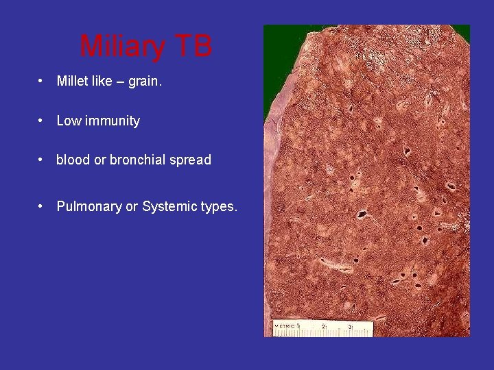 Miliary TB • Millet like – grain. • Low immunity • blood or bronchial