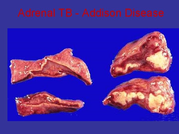 Adrenal TB - Addison Disease 