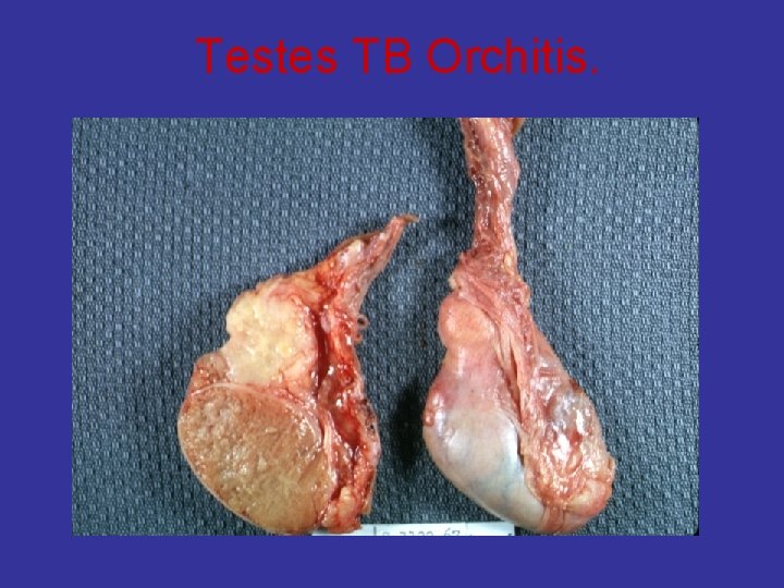 Testes TB Orchitis. 