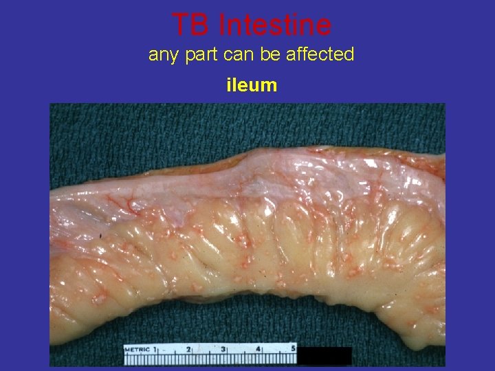 TB Intestine any part can be affected ileum 