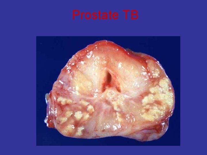 Prostate TB 