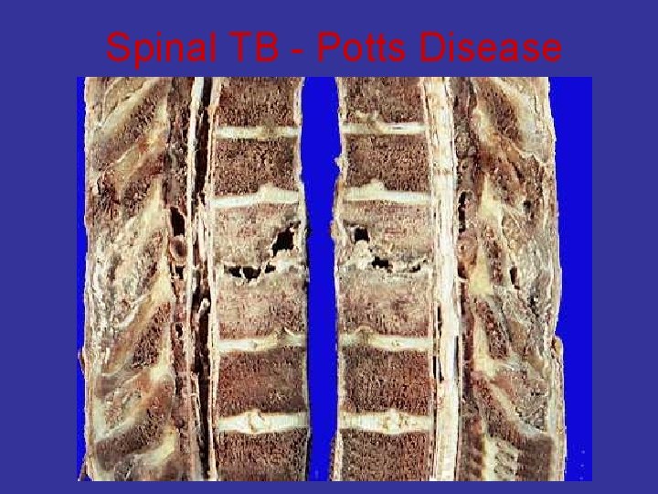 Spinal TB - Potts Disease 