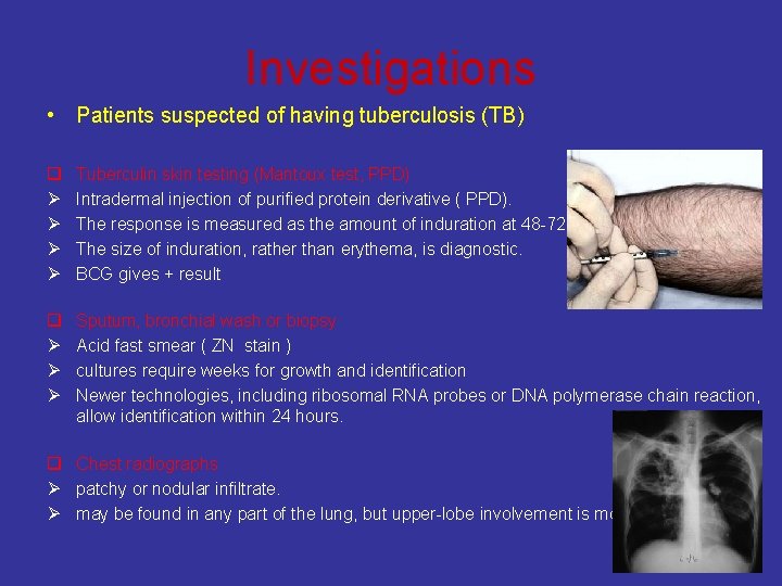 Investigations • Patients suspected of having tuberculosis (TB) q Ø Ø Tuberculin skin testing