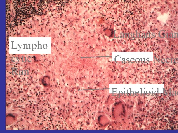 Lympho cytic Rim Langhans Gian Caseous Necro Epithelioid Mac 