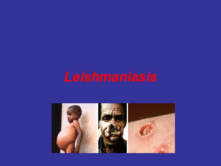 Leishmaniasis 