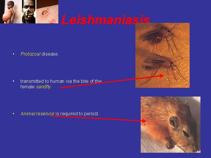 Leishmaniasis • Protozoal disease. • transmitted to human via the bite of the female