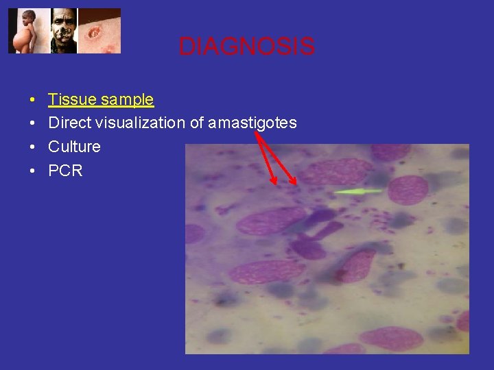 DIAGNOSIS • • Tissue sample Direct visualization of amastigotes Culture PCR 